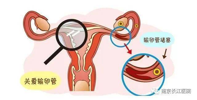 通草的功效与作用能通输卵管堵塞,适用计划解析方案_W80.327